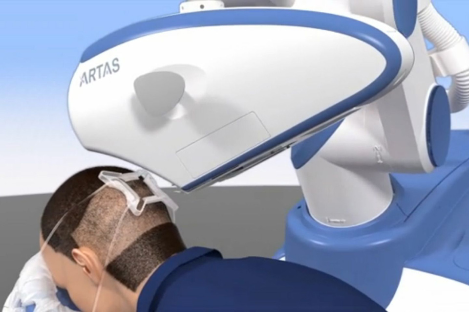 Роботизированная система по трансплантации волос ARTAS